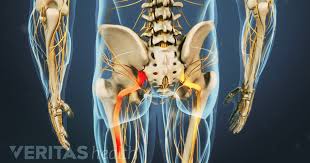 Sciatica Pain