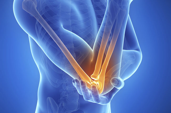 Tennis Elbow