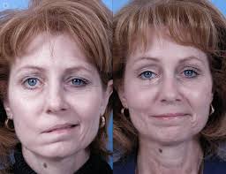 Bell's Palsy
